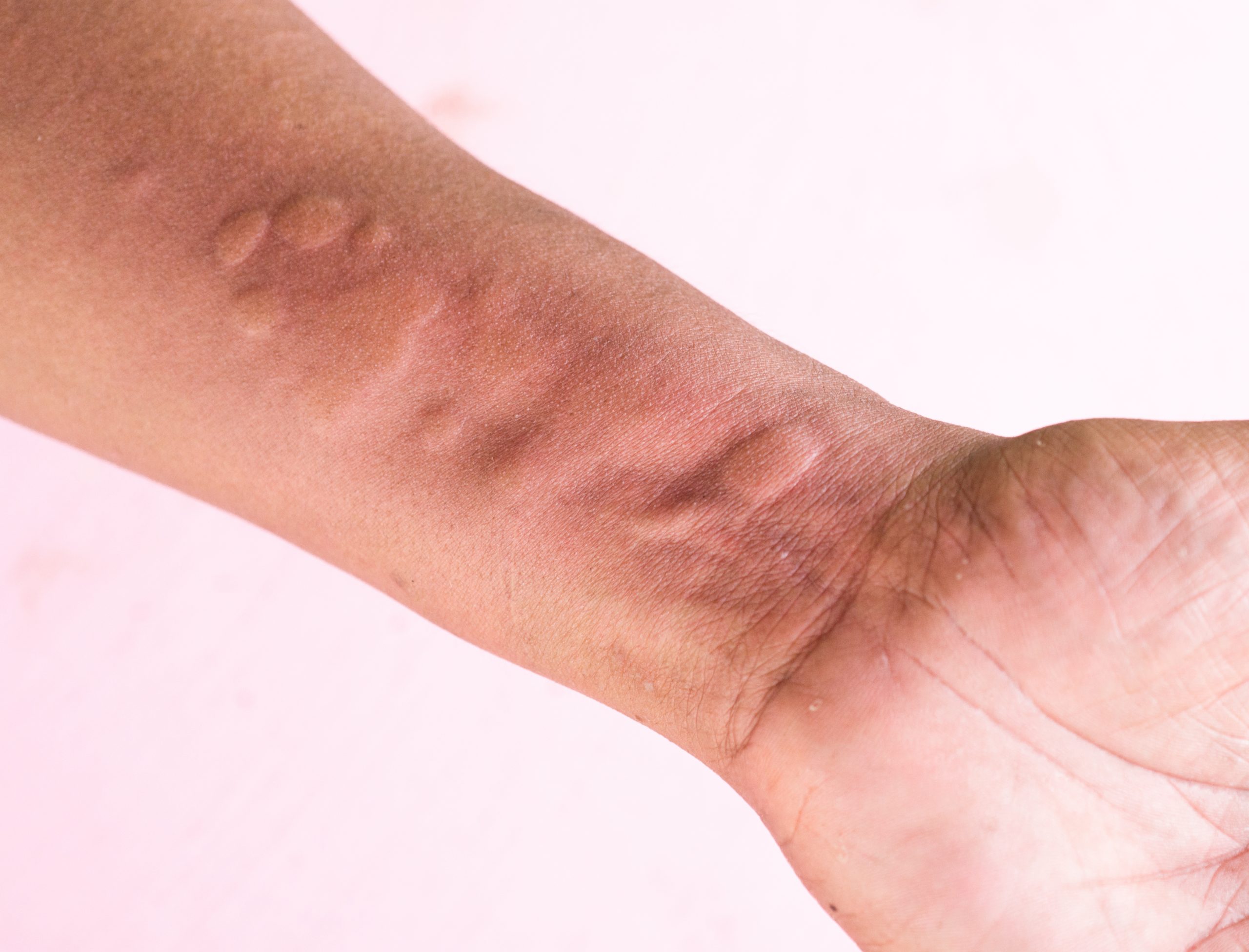 What Causes Itchy Skin After Menopause