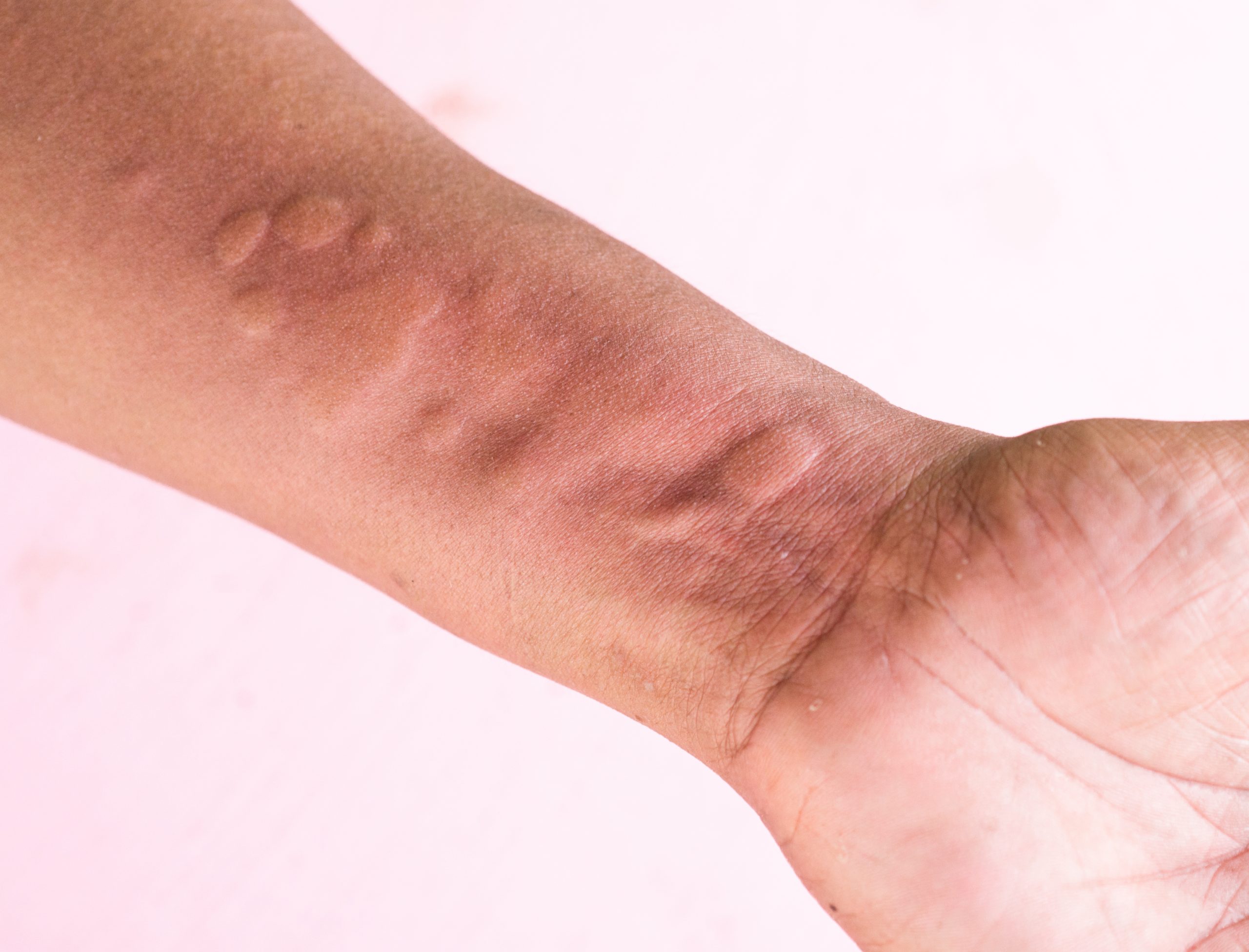 Urticaria